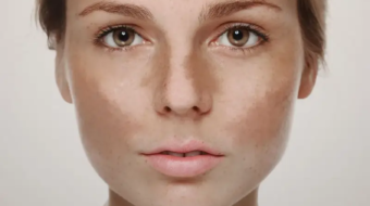 melasma